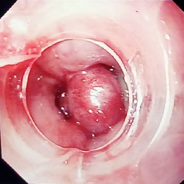 Cargar imagen en el visor de la galería, Ligador várices esofágicas
