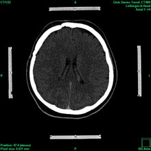 Cargar imagen en el visor de la galería, Neurocirugía funcional iPS