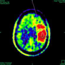 Cargar imagen en el visor de la galería, Neurocirugía funcional iPS
